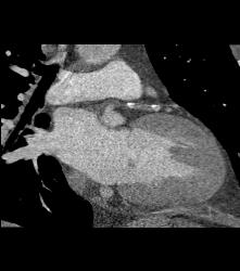 Left Anterior Descending Coronary Artery (LAD) Plaque With Significant Stenosis - CTisus CT Scan