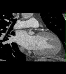 Left Anterior Descending Coronary Artery (LAD) Plaque With Significant Stenosis - CTisus CT Scan