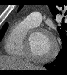 Left Anterior Descending Coronary Artery (LAD) Plaque With Significant Stenosis - CTisus CT Scan