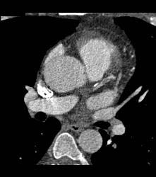 Left Anterior Descending Coronary Artery (LAD) Plaque With Significant Stenosis - CTisus CT Scan