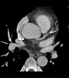 Left Anterior Descending Coronary Artery (LAD) Plaque With Significant Stenosis - CTisus CT Scan