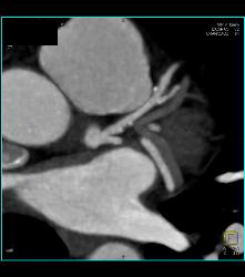 Left Anterior Descending Coronary Artery (LAD) Plaque and Right Dominant Circulation - CTisus CT Scan