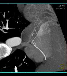 Left Anterior Descending Coronary Artery (LAD) Plaque and Right Dominant Circulation - CTisus CT Scan