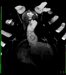 Dilated Reimplanted Right Coronary Cusp - Coronary Artery Aneurysm - CTisus CT Scan