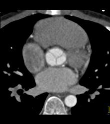 Dilated Reimplanted Right Coronary Cusp - Coronary Artery Aneurysm - CTisus CT Scan