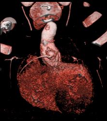 Dilated Reimplanted Right Coronary Cusp - Coronary Artery Aneurysm - CTisus CT Scan