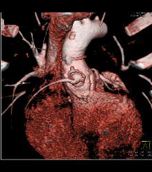 Dilated Reimplanted Right Coronary Cusp - Coronary Artery Aneurysm - CTisus CT Scan