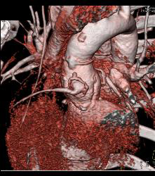 Dilated Reimplanted Right Coronary Cusp - Coronary Artery Aneurysm - CTisus CT Scan