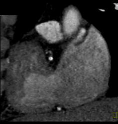 RCA Plaque - CTisus CT Scan