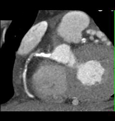 RCA Plaque - CTisus CT Scan