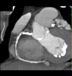 RCA Plaque - CTisus CT Scan