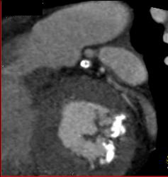 Left Anterior Descending Coronary Artery (LAD) Stenosis With Calcified Plaque - CTisus CT Scan