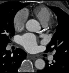 Left Anterior Descending Coronary Artery (LAD) Stenosis With Calcified Plaque - CTisus CT Scan