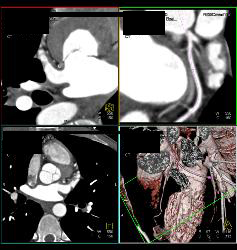 Normal Left Anterior Descending Coronary Artery (LAD) and Circumflex Artery (CX) - CTisus CT Scan