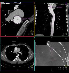 Dilated Ascending Aorta - CTisus CT Scan