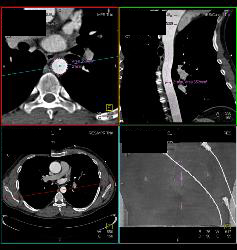 Dilated Ascending Aorta - CTisus CT Scan