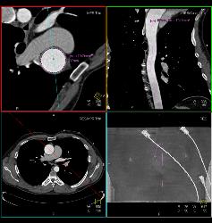 Dilated Ascending Aorta - CTisus CT Scan