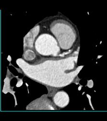 Dilated Root With Left Anterior Descending Coronary Artery (LAD) Plaque - CTisus CT Scan