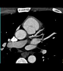 Left Anterior Descending Coronary Artery (LAD) Plaque - CTisus CT Scan