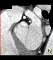 Mixed Plaque on Left Anterior Descending Coronary Artery (LAD) W/o Significant Stenosis - in Multiple Views - CTisus CT Scan