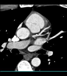 Mixed Plaque on Left Anterior Descending Coronary Artery (LAD) W/o Significant Stenosis - in Multiple Views - CTisus CT Scan