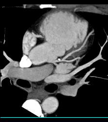 Mixed Plaque on Left Anterior Descending Coronary Artery (LAD) W/o Significant Stenosis - in Multiple Views - CTisus CT Scan