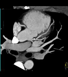 Mixed Plaque on Left Anterior Descending Coronary Artery (LAD) W/o Significant Stenosis - in Multiple Views - CTisus CT Scan