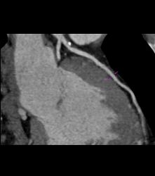 Mixed Plaque on Left Anterior Descending Coronary Artery (LAD) W/o Significant Stenosis - in Multiple Views - CTisus CT Scan