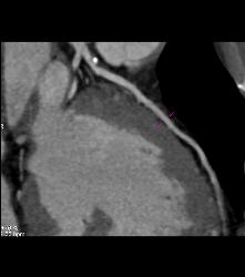 Mixed Plaque on Left Anterior Descending Coronary Artery (LAD) W/o Significant Stenosis - in Multiple Views - CTisus CT Scan