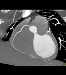 Right Dominant Circulation - CTisus CT Scan