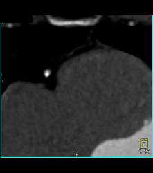 Right Dominant Circulation - CTisus CT Scan