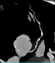 Multiple Calcified Plaques in Left Anterior Descending Coronary Artery (LAD) in A Range of Perspectives - CTisus CT Scan