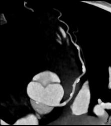 Multiple Calcified Plaques in Left Anterior Descending Coronary Artery (LAD) in A Range of Perspectives - CTisus CT Scan