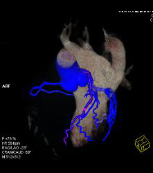 Multiple Calcified Plaques in Left Anterior Descending Coronary Artery (LAD) in A Range of Perspectives - CTisus CT Scan