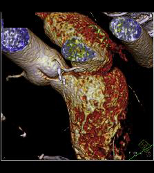 Multiple Calcified Plaques in Left Anterior Descending Coronary Artery (LAD) in A Range of Perspectives - CTisus CT Scan