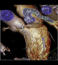 Multiple Calcified Plaques in Left Anterior Descending Coronary Artery (LAD) in A Range of Perspectives - CTisus CT Scan