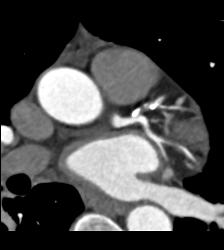 Multiple Calcified Plaques in Left Anterior Descending Coronary Artery (LAD) in A Range of Perspectives - CTisus CT Scan