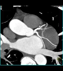 Multiple Calcified Plaques in Left Anterior Descending Coronary Artery (LAD) in A Range of Perspectives - CTisus CT Scan