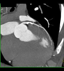 Multiple Calcified Plaques in Left Anterior Descending Coronary Artery (LAD) in A Range of Perspectives - CTisus CT Scan