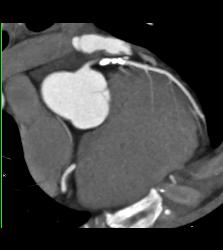 Multiple Calcified Plaques in Left Anterior Descending Coronary Artery (LAD) in A Range of Perspectives - CTisus CT Scan