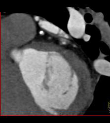 Multiple Calcified Plaques in Left Anterior Descending Coronary Artery (LAD) in A Range of Perspectives - CTisus CT Scan