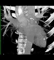 Multiple Calcified Plaques in Left Anterior Descending Coronary Artery (LAD) in A Range of Perspectives - CTisus CT Scan