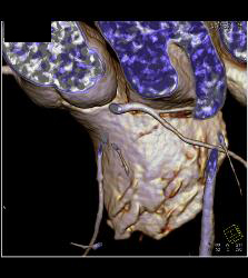 Multiple Calcified Plaques in Left Anterior Descending Coronary Artery (LAD) in A Range of Perspectives - CTisus CT Scan