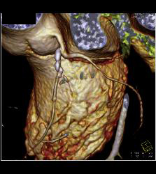 Multiple Calcified Plaques in Left Anterior Descending Coronary Artery (LAD) in A Range of Perspectives - CTisus CT Scan