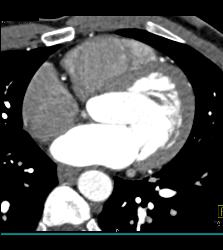 Multiple Calcified Plaques in Left Anterior Descending Coronary Artery (LAD) in A Range of Perspectives - CTisus CT Scan