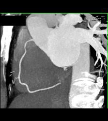 Minimal Plaque Right Coronary Artery (RCA) and Left Anterior Descending Coronary Artery (LAD) - CTisus CT Scan