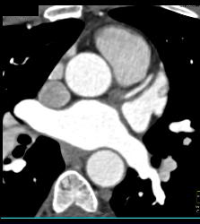 Minimal Plaque Right Coronary Artery (RCA) and Left Anterior Descending Coronary Artery (LAD) - CTisus CT Scan