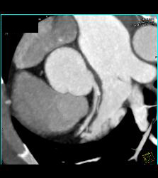 Minimal Plaque Right Coronary Artery (RCA) and Left Anterior Descending Coronary Artery (LAD) - CTisus CT Scan