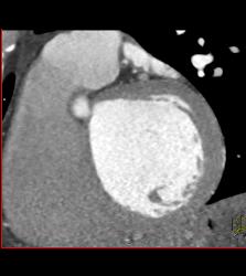 Minimal Plaque Right Coronary Artery (RCA) and Left Anterior Descending Coronary Artery (LAD) - CTisus CT Scan