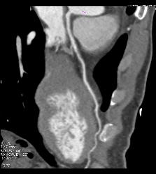 Minimal Plaque Right Coronary Artery (RCA) and Left Anterior Descending Coronary Artery (LAD) - CTisus CT Scan